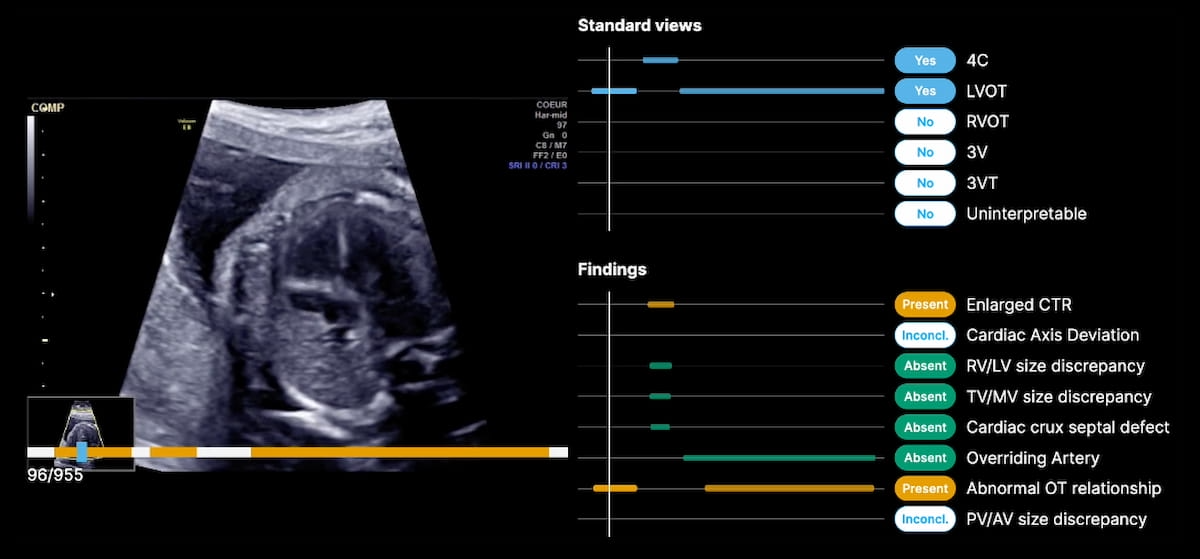 FDA clears wave of fetal ultrasound AI, from biometry to anomaly ...